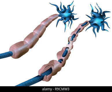 Multiple sclerosis or MS autoimmune disease with healthy nerve and damaged myelin with exposed fibre with scarrred schwann cell sheath loss. Stock Photo