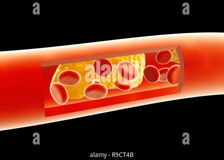 Atherosclerosis - clogged artery and erythrocytes Stock Photo