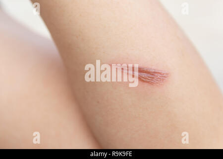 Hot wound, Arm scald, Wounds caused by scalding hot water Stock Photo