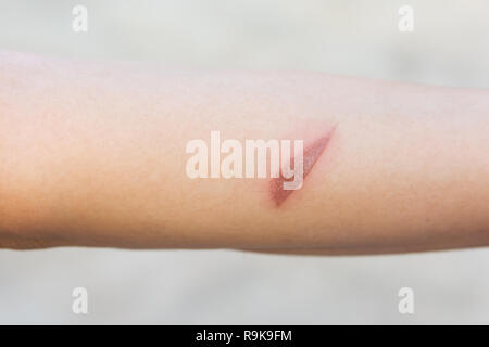 Hot wound, Arm scald, Wounds caused by scalding hot water Stock Photo