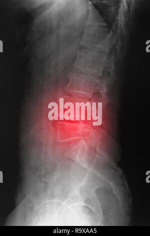 Computed radiography (CR) of lumbosarcal spine  lateral showing spondylosis and scoliosis spine. Stock Photo