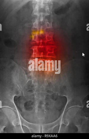 Computed radiography (CR) of lumbosarcal spine anteroposterior(AP) showing spondylosis and scoliosis spine. Stock Photo