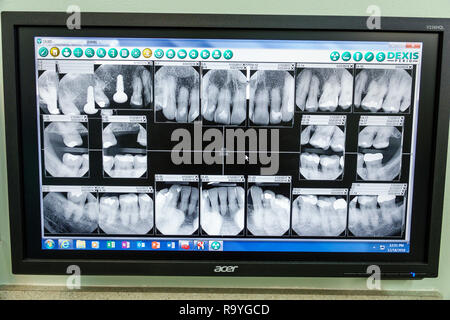 Miami Beach Florida,xrays x-rays,teeth mouth fillings implant crown,dentist periodontist office examination room,FL181222024 Stock Photo