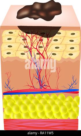 The structure of the nevus. The structure of moles on the skin. Infographics. Vector illustration on isolated background Stock Vector