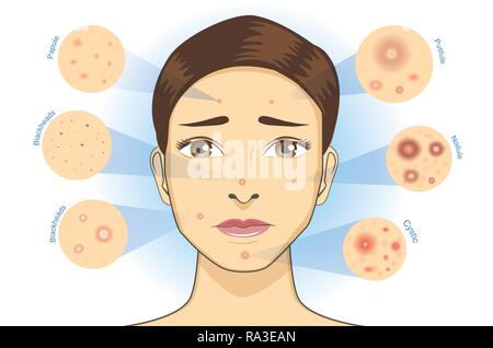 Facial woman with type of acne skin icon. Stock Vector