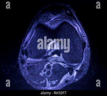 Magnetic Resonance Imaging Mri Knee Posterior Horn Medial Meniscus Tear 