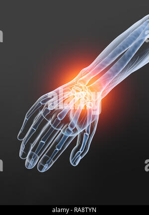 Rheumatoid arthritis wrist joint, medically 3D illustration Stock Photo