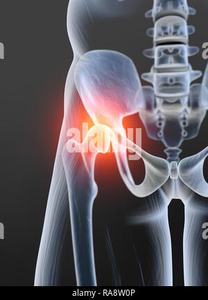 X ray osteoarthritis of the hip joint Stock Photo: 4055288 - Alamy