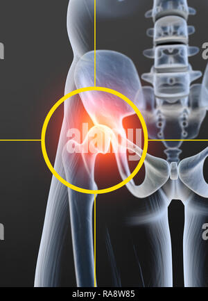 Osteoarthritis hip joint, medically 3D illustration Stock Photo