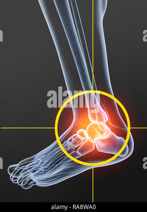 Osteoarthritis ankle joint, 3D illustration Stock Photo