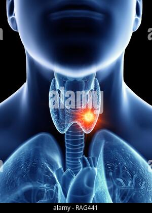 Illustration of a man's throat anatomy cancer. Stock Photo