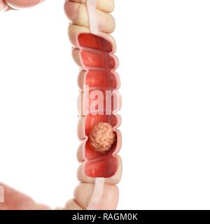 Illustration of a colon tumour. Stock Photo