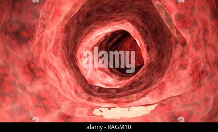 Illustration of an inflamed colon. Stock Photo