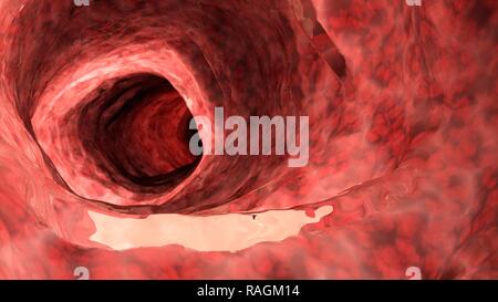 Illustration of an inflamed colon. Stock Photo