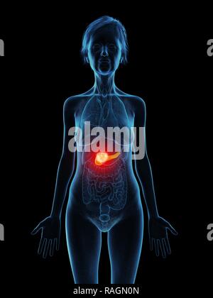 Illustration of an old woman's pancreas tumour. Stock Photo