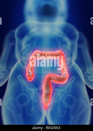 Illustration of an inflamed colon. Stock Photo