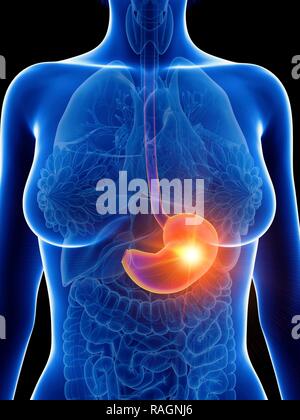 Illustration of a woman's inflamed stomach. Stock Photo