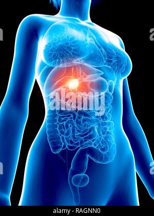 Illustration of a woman's painful gallbladder. Stock Photo