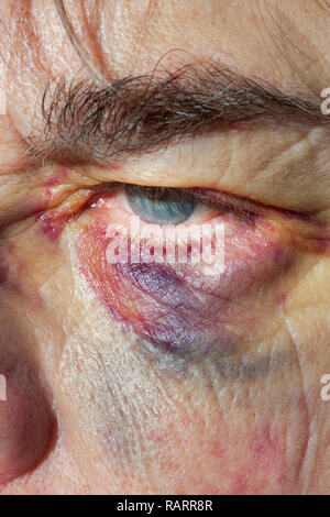 Close up of a woman with a black eye. Stock Photo