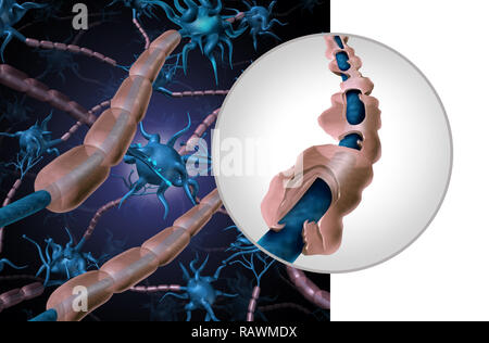 Multiple sclerosis myelin disease or MS autoimmune disorder with healthy nerve with exposed fibre with scarrred cell sheath loss. Stock Photo