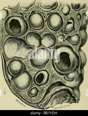 'Tumours, innocent and malignant; their clinical characters and appropriate treatment' (1911) Stock Photo