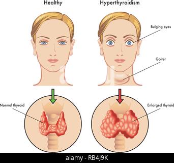 Medical illustration of the main symptoms of hyperthyroidism Stock Vector