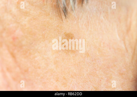 Old Age Spot Stock Photo Alamy