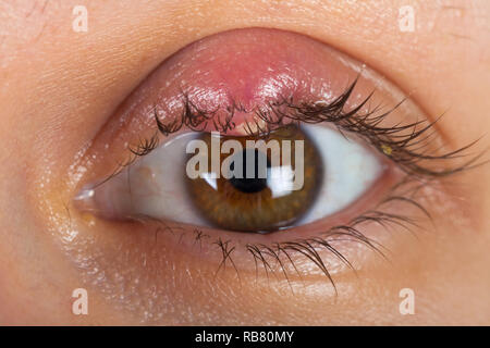 Eye stye (sty or hordeolum Stock Photo - Alamy