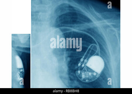 Artificial cardiac pacemaker with human heart, 3D rendering isolated on ...