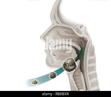 THROAT CANCER ILLUSTRATION Stock Photo