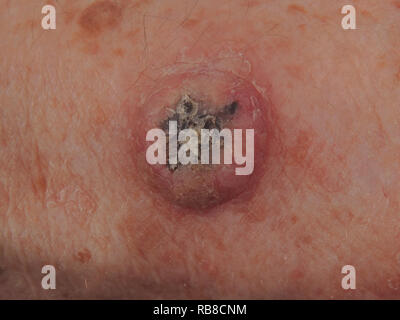 SQUAMOUS CELL CARCINOMA Stock Photo