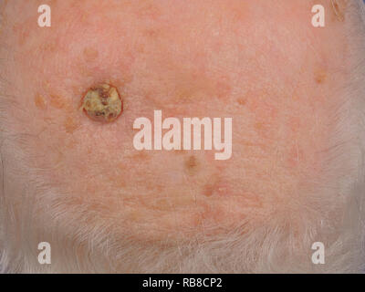 SQUAMOUS CELL CARCINOMA Stock Photo