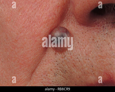 BASAL CELL CARCINOMA Stock Photo