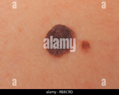 intradermal nevus