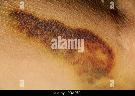 Bruise on skin of hand of an elderly woman, close-up photo Stock Photo