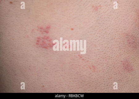 Shingles disease, herpes zoster, blisters on body, varicella-zoster virus, skin rash Stock Photo