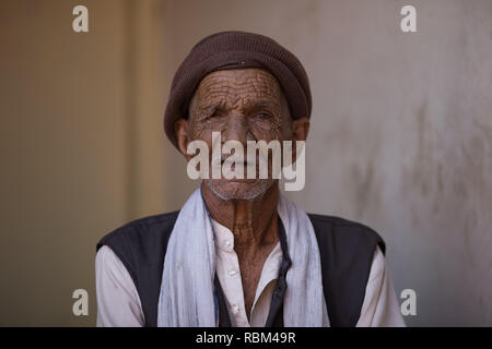 India. 2nd Apr, 2017. A patient seen at Sambhavna Clinic.Sambhavna Clinic Cares for victims of the Bhopal Gas Disaster.The Bhopal Gas Disaster was a gas leak incident on the night of 2-3 December 1984 at the Union Carbide plant in Bhopal. Over 500,000 people were exposed to the toxic methyl isocyanate (MIC) gas as they slept. The final death toll is estimated to be between 15,000 and 20,000. Credit: Ryan Ashcroft/SOPA Images/ZUMA Wire/Alamy Live News Stock Photo