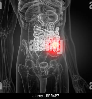 Illustration of small intestine cancer. Stock Photo