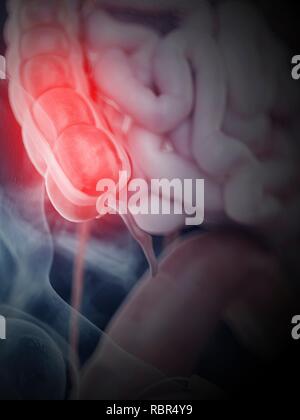 Illustration of an inflamed colon. Stock Photo