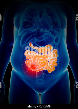 Illustration of bowel cancer. Stock Photo