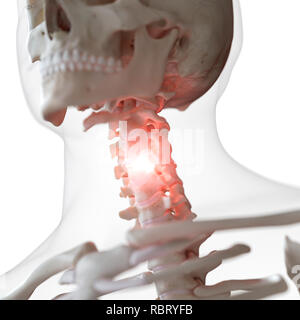 Illustration of a painful cervical spine. Stock Photo