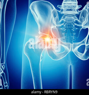 Illustration of a painful hip joint. Stock Photo