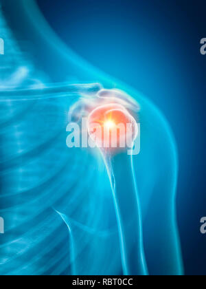 Illustration of a painful shoulder. Stock Photo