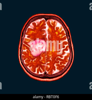 Glioblastoma brain cancer. Coloured computed tomography (CT) scan of a section through the brain of an 84-year-old female patient with glioblastoma (dark, left). Glioblastoma is the most aggressive form of brain cancer. Treatment involves surgery, after which chemotherapy and radiation therapy are used. However, the cancer usually reoccurs despite treatment and the most common length of survival after diagnosis is 12-15 months. Without treatment, survival is typically 3 months. Stock Photo