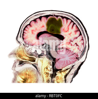 Glioblastoma brain cancer. Coloured computed tomography (CT) scan of a section through the brain of an 84-year-old female patient with glioblastoma (dark, top). Glioblastoma is the most aggressive form of brain cancer. Treatment involves surgery, after which chemotherapy and radiation therapy are used. However, the cancer usually reoccurs despite treatment and the most common length of survival after diagnosis is 12-15 months. Without treatment, survival is typically 3 months. Stock Photo