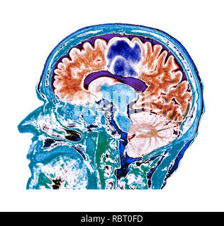 Glioblastoma brain cancer. Coloured computed tomography (CT) scan of a section through the brain of an 84-year-old female patient with glioblastoma (blue, top). Glioblastoma is the most aggressive form of brain cancer. Treatment involves surgery, after which chemotherapy and radiation therapy are used. However, the cancer usually reoccurs despite treatment and the most common length of survival after diagnosis is 12-15 months. Without treatment, survival is typically 3 months. Stock Photo