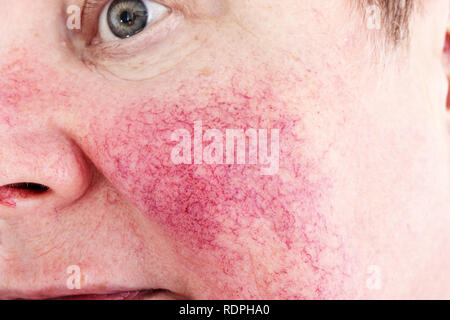 Portrait of unhappy elderly woman suffering skin disease rosacea with no make-up