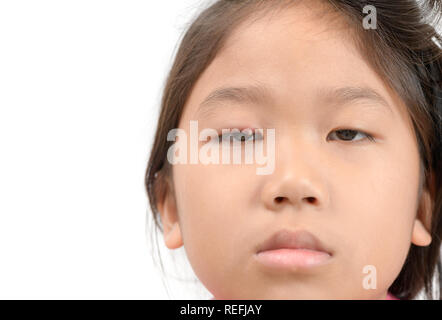 Close up of asian little girl one eye infection isolated on white background, eyelid abscess, stye, hordeolum. Concept of health, disease Stock Photo