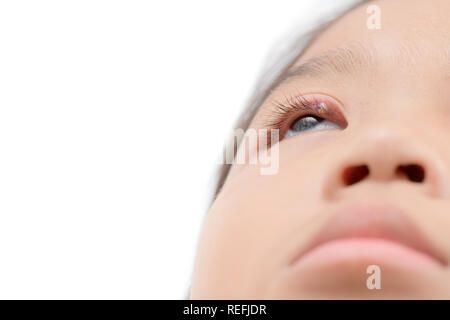 Close up of asian little girl one eye infection isolated on white background, eyelid abscess, stye, hordeolum. Concept of health, disease Stock Photo