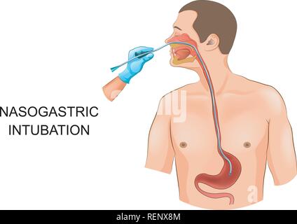 vector illustration of nasogastric intubation. tube in the stomach Stock Vector